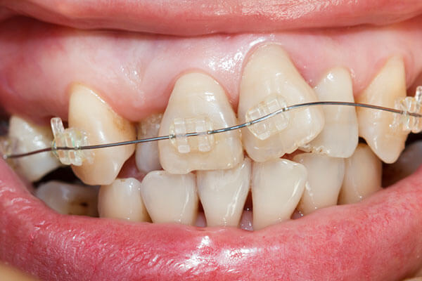 braces for severe crowding