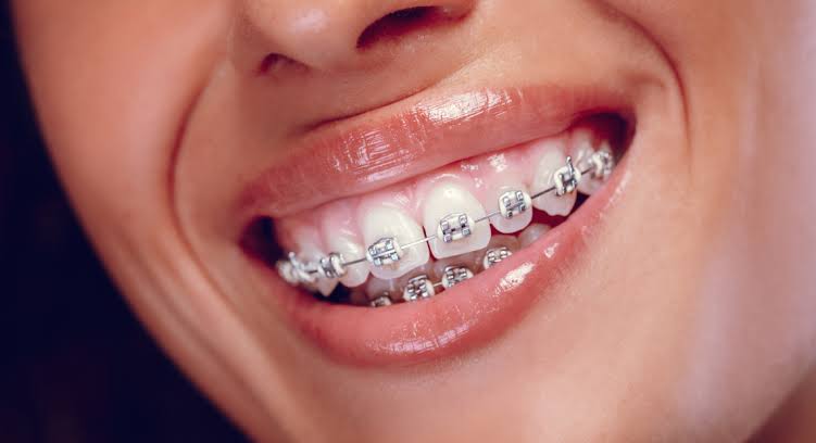Does CDCP cover braces in 2026?