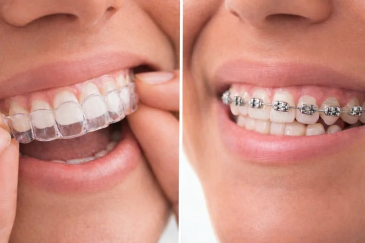 A picture representing braces vs invisalign