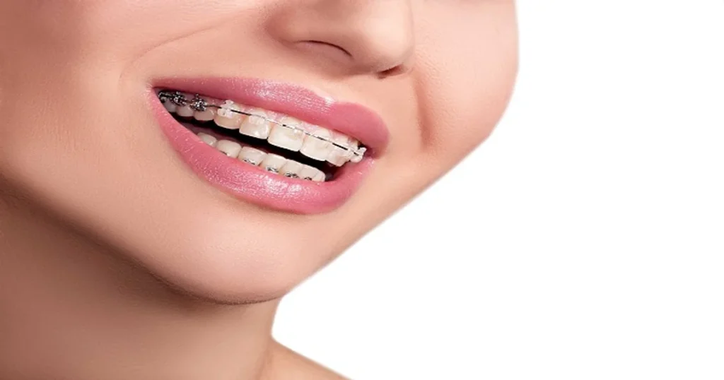 A picture of a woman with braces