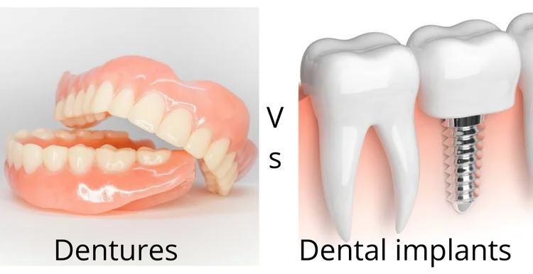 a picture representing the comparison between implants vs dentures