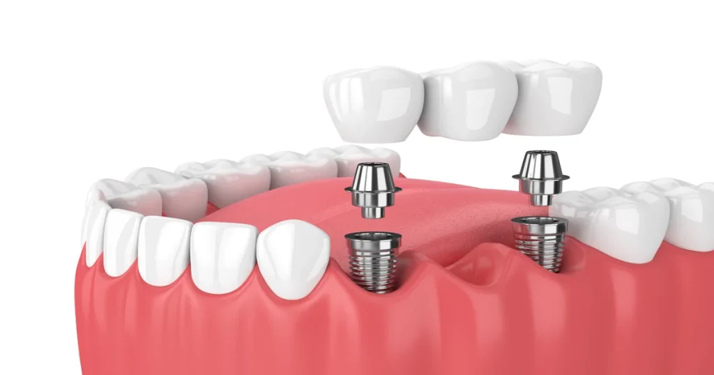 a picture representing dental implants