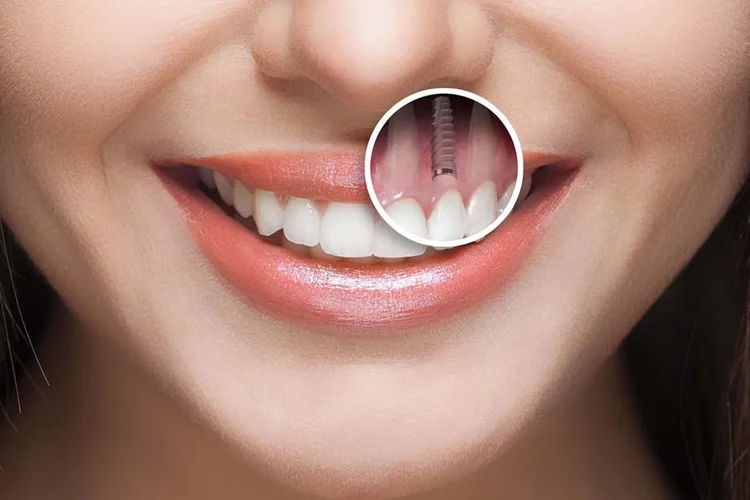 A picture showcasing dental implants